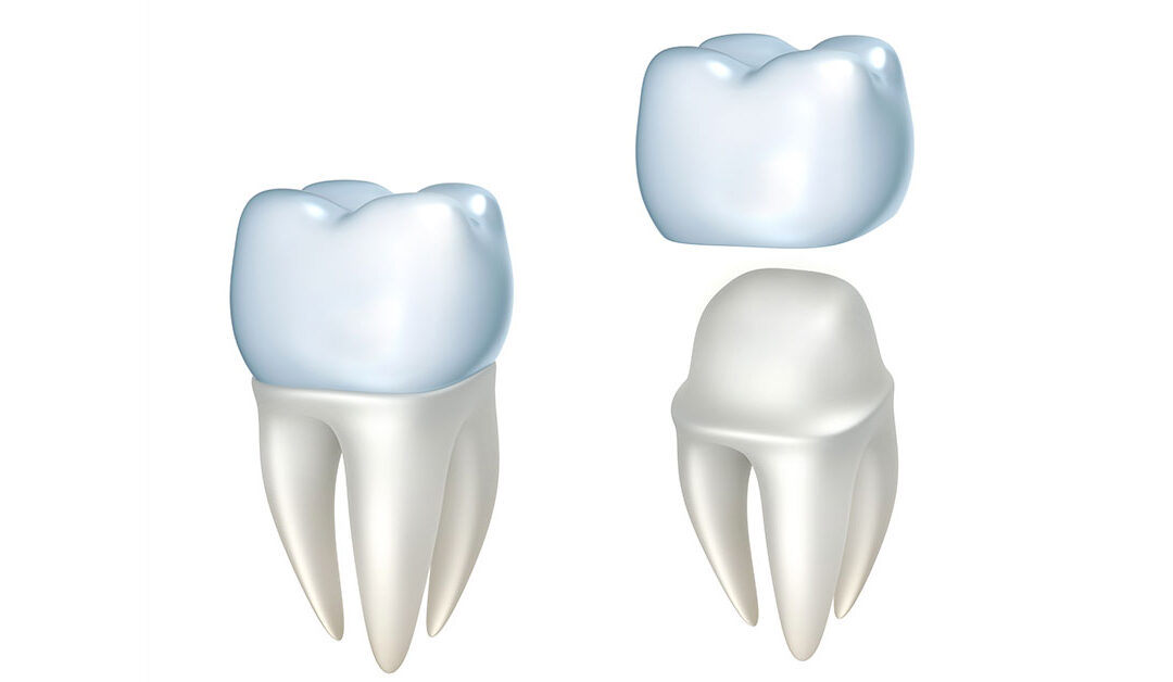 Six Ways that Dentists Can Use Dental Crowns