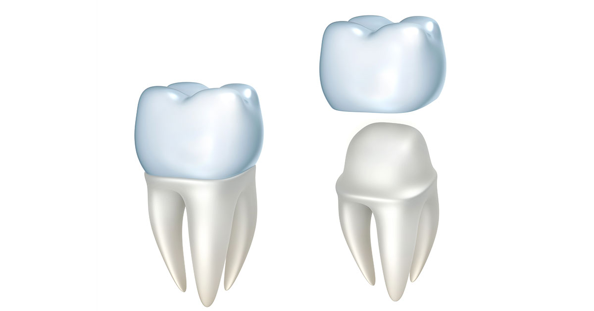 Illustration of how dental crowns sit on natural teeth