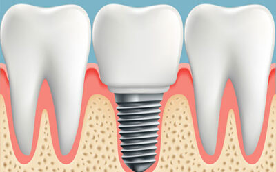 Do you qualify for dental implants? Find out now!