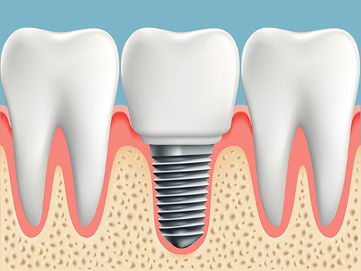 Do you qualify for dental implants? Find out now!