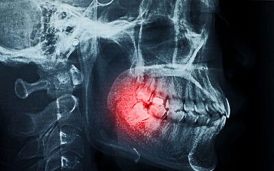 Tips for Faster Healing After Wisdom Tooth Extractions