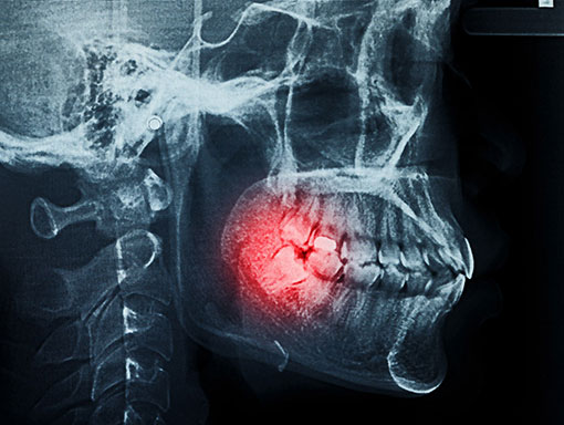 X-ray image of wisdom teeth