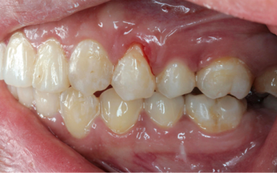Your Guide to Dental Cleanings: Regular Prophy vs. Perio Maintenance