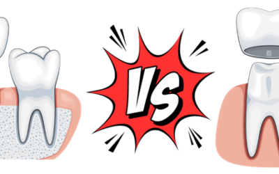 Dental Implants VS Crowns: Which Is Right for You?