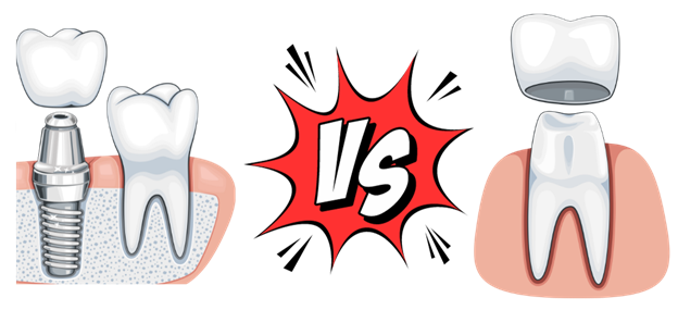 Dental Implants VS Crowns: Which Is Right for You?