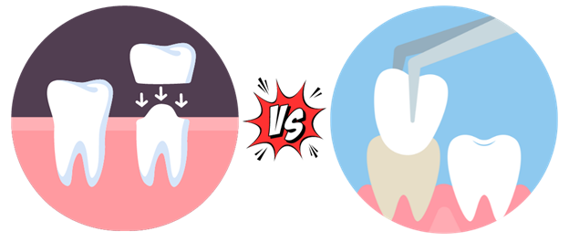 Dental Crowns vs. Veneers: A Comprehensive Guide to Enhancing Your Smile