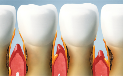 A Comprehensive Guide to Gum Disease: Gingivitis vs. Periodontitis and How to Protect Your Smile