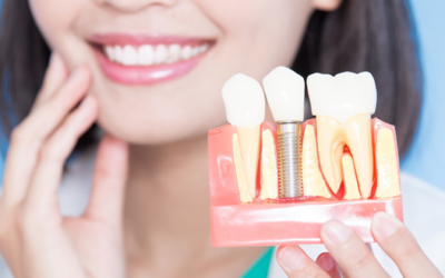 7 Top Reasons to Choose Dental Implants