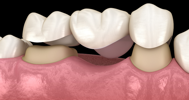 The Top Reasons to Choose Dental Bridges