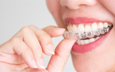 Smile with Confidence: Discover Why Invisalign Is the Way to Go